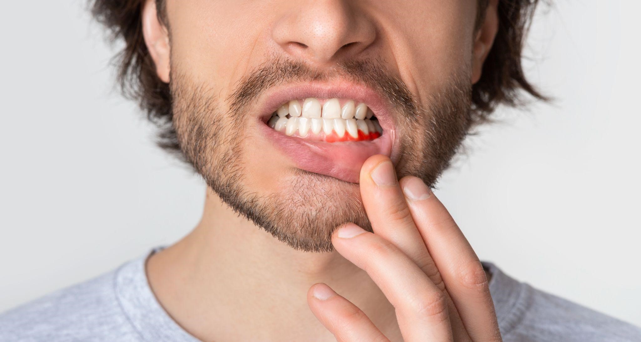 man with gum disease